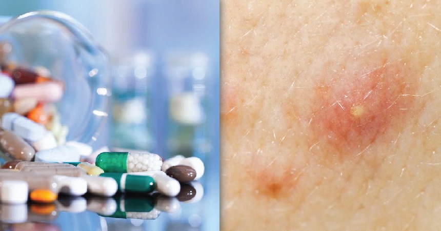 Dosing for Accutane® (Isotretinoin)