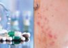 Accutane Side Effects