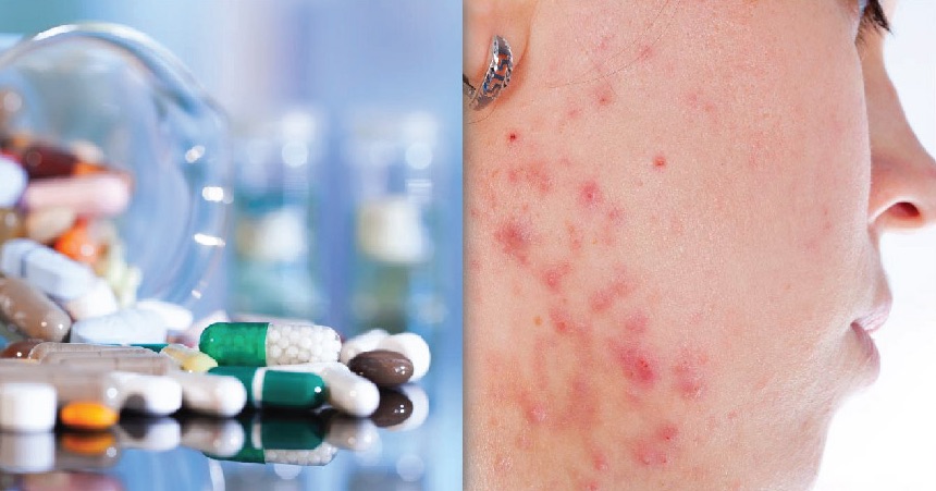 Accutane Side Effects