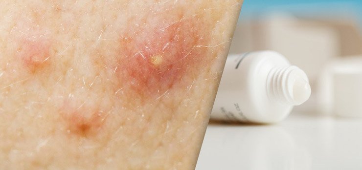 Acne Clindamycin/Tretinoin Preparation