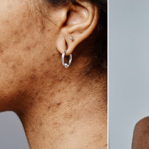 PDF: A Multimodal Approach to Acne-Induced Post-Inflammatory Hyperpigmentation: Trifarotene as a Long-Term Intervention