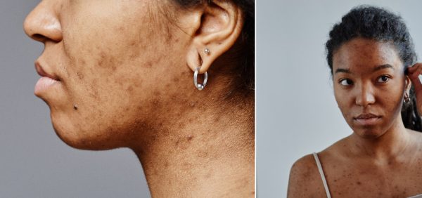 PDF: A Multimodal Approach to Acne-Induced Post-Inflammatory Hyperpigmentation: Trifarotene as a Long-Term Intervention