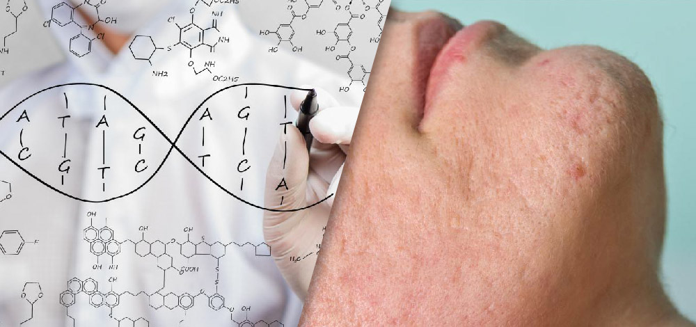 Adapalene/Benzoyl Peroxide image