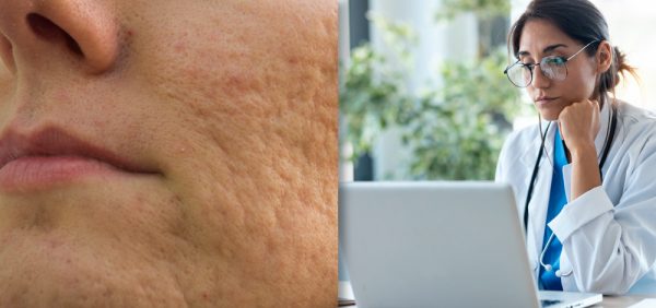 collage image of acne scars on skin and doctor looking at her laptop