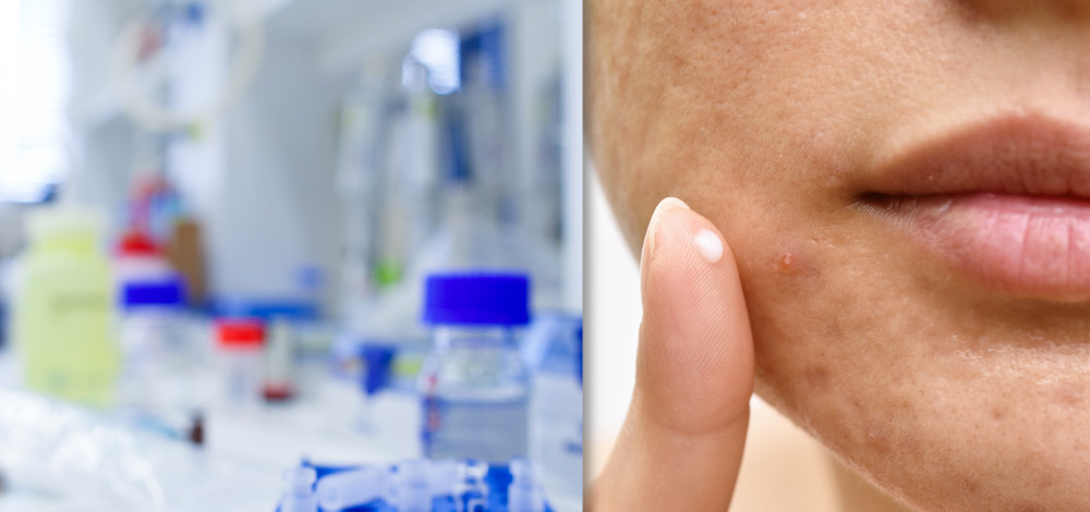 picture of girl with acne face using topical cream