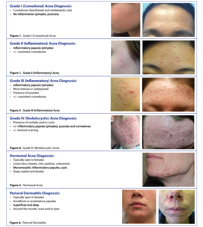 Types of acne and diagnosis 