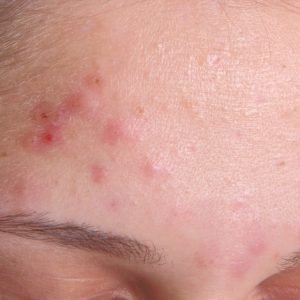 image of Adult Female Acne