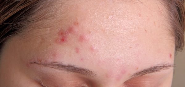 image of Adult Female Acne