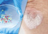 image of an elbow affected by psoriasis and medical research trial