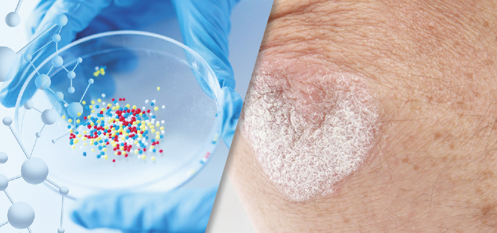 image of an elbow affected by psoriasis and medical research trial