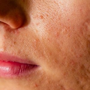 image of a woman's face with Atrophic Acne Scars
