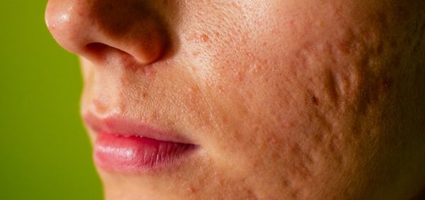 image of a woman's face with Atrophic Acne Scars