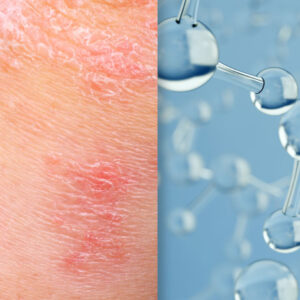 Bimekizumab and Psoriasis and science image collage