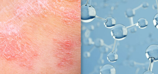 Bimekizumab and Psoriasis and science image collage