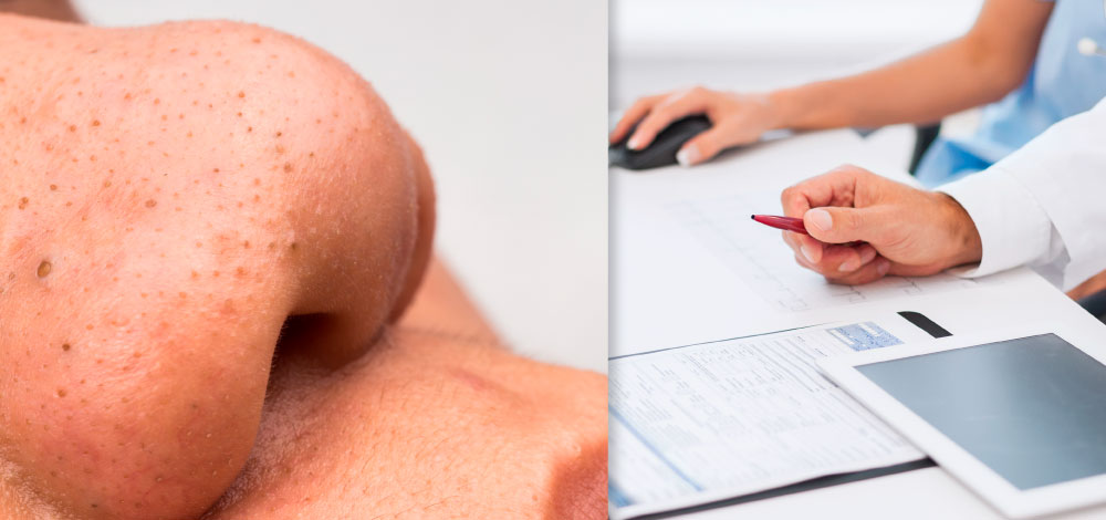 pic for New Canadian Guideline for Acne Treatment