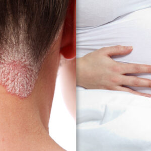Certolizumab Pegol Psoriasis and pregnant woman image