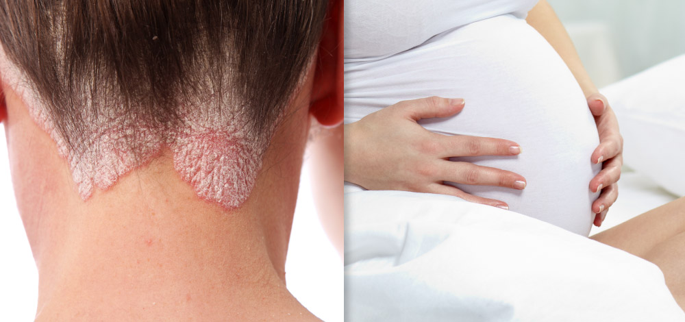 Certolizumab Pegol Psoriasis and pregnant woman image