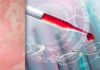Chronic Urticaria and Autoimmunity