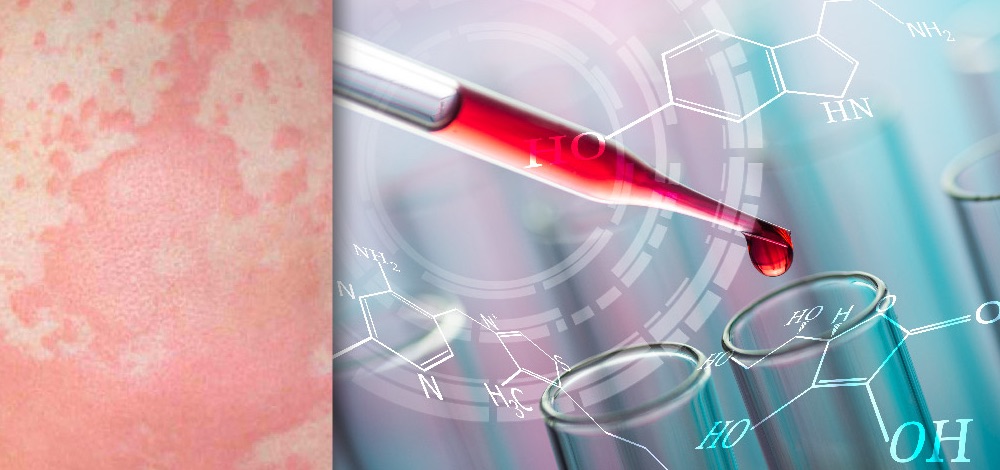 Chronic Urticaria and Autoimmunity