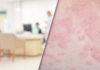 Chronic Urticaria