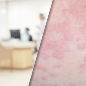 Chronic Urticaria