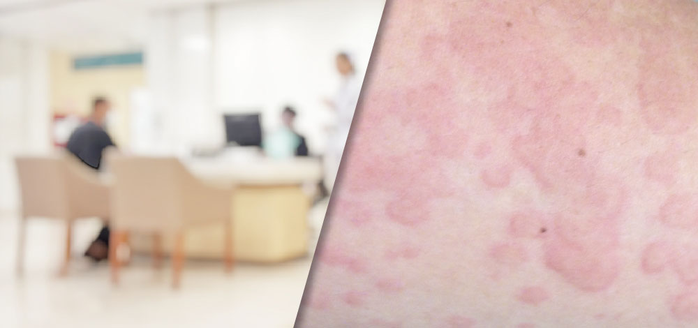 Chronic Urticaria