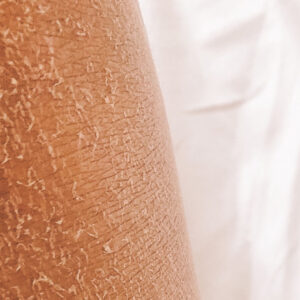 image of dry skin, probably