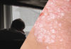 Psoriasis, Depression, and Suicidality