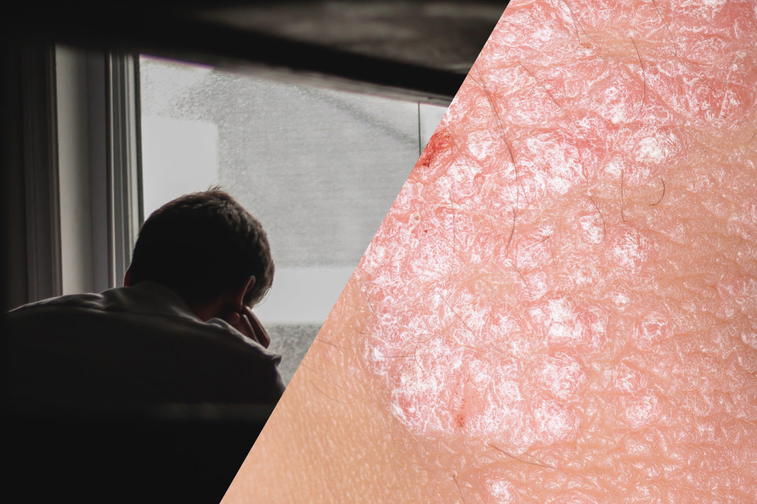 Psoriasis, Depression, and Suicidality