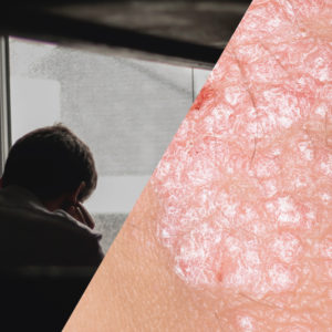 Psoriasis, Depression, and Suicidality