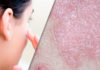 Dermatologic Uses of Methotrexate image