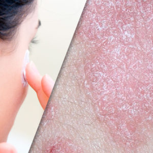 Dermatologic Uses of Methotrexate image