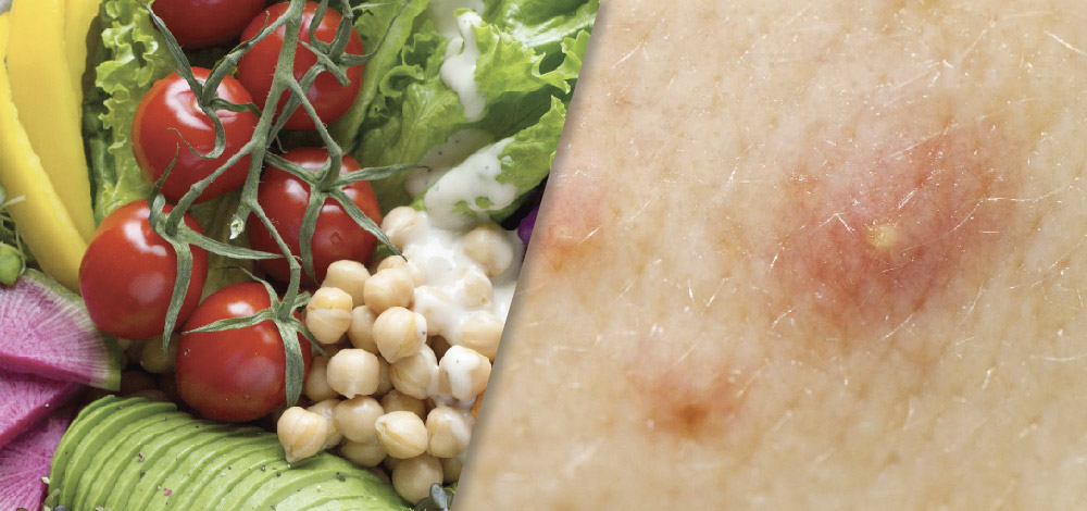 Collage image of healthy food and human skin affected by acne