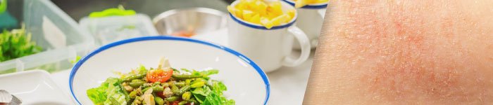 How Diet affects Atopic Dermatitis (Eczema)