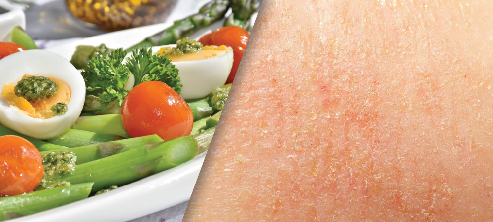 Review of Evidence for Dietary Influences on Atopic Dermatitis