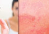 Dupilumab for Moderate-to-Severe Atopic Dermatitis