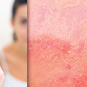 Dupilumab for Moderate-to-Severe Atopic Dermatitis