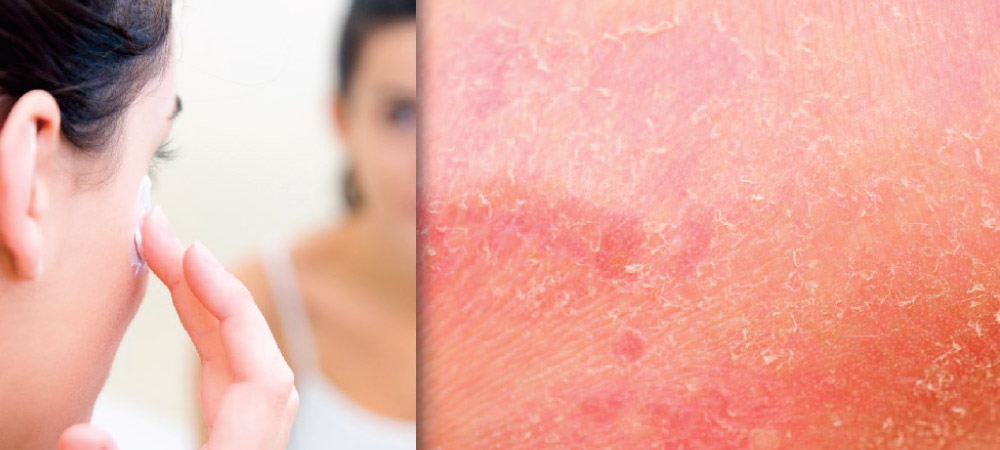Dupilumab for Moderate-to-Severe Atopic Dermatitis