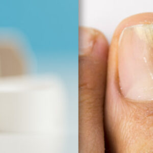 image of infected toenail