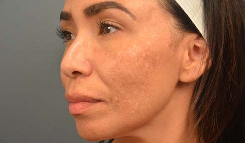 Melasma and Post Inflammatory Hyperpigmentation: Management Update and Expert Opinion - image