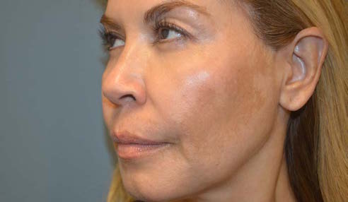 Melasma and Post Inflammatory Hyperpigmentation: Management Update and Expert Opinion - image