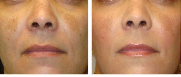topical triple therapy and 2 treatments of full-face 20% salicylic acid peels.