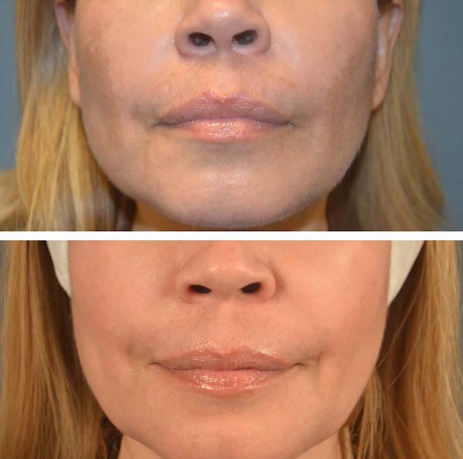 Combination treatment, Clear + Brilliant®