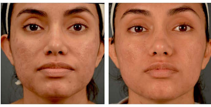 Melasma and Post Inflammatory Hyperpigmentation: Management Update and Expert Opinion - image