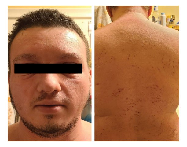 Real-World Insights from Atopic Dermatitis Patients Treated with Abrocitinib - image