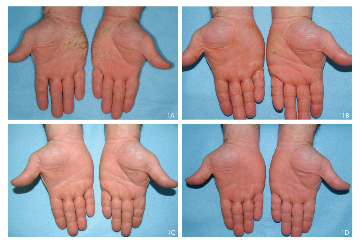 Progress of alitretinoin treatment 