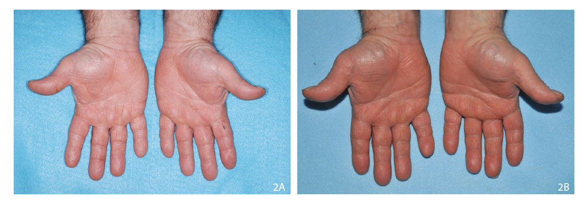 Progress of alitretinoin treatment 