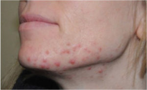 Hormonal Acne