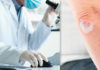 Guselkumab IL 23 Inhibitor for Psoriasis