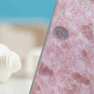image of Seborrheic Keratoses skin